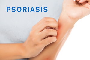 Everything you need to know about PSORIASIS